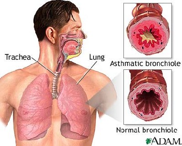 Ilustracja astmy