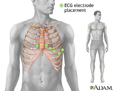 Umiejscowienie elektrod przedsercowych
