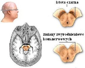 Ilustracja choroby Parkinsona