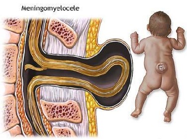 Schemat anatomiczny przepukliny oponowo-rdzeniowej