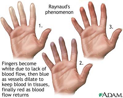 raynauds