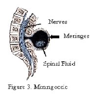 Meningocele