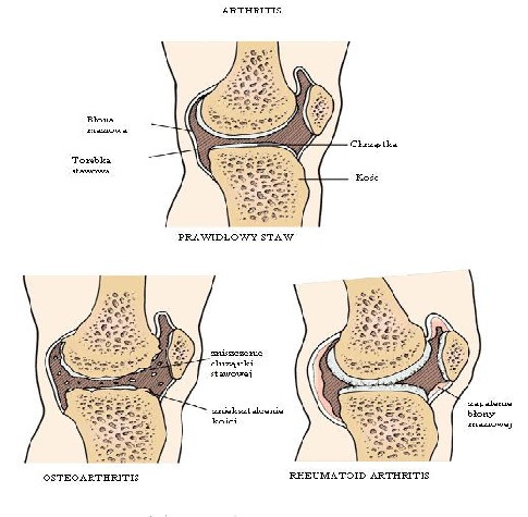 Rheumatoid arthritis