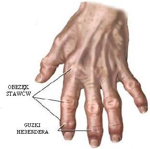 Zmiany zwyrodnieniowe - obraz