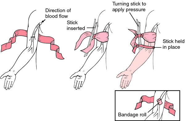 perthes