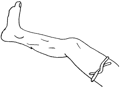 perthes2